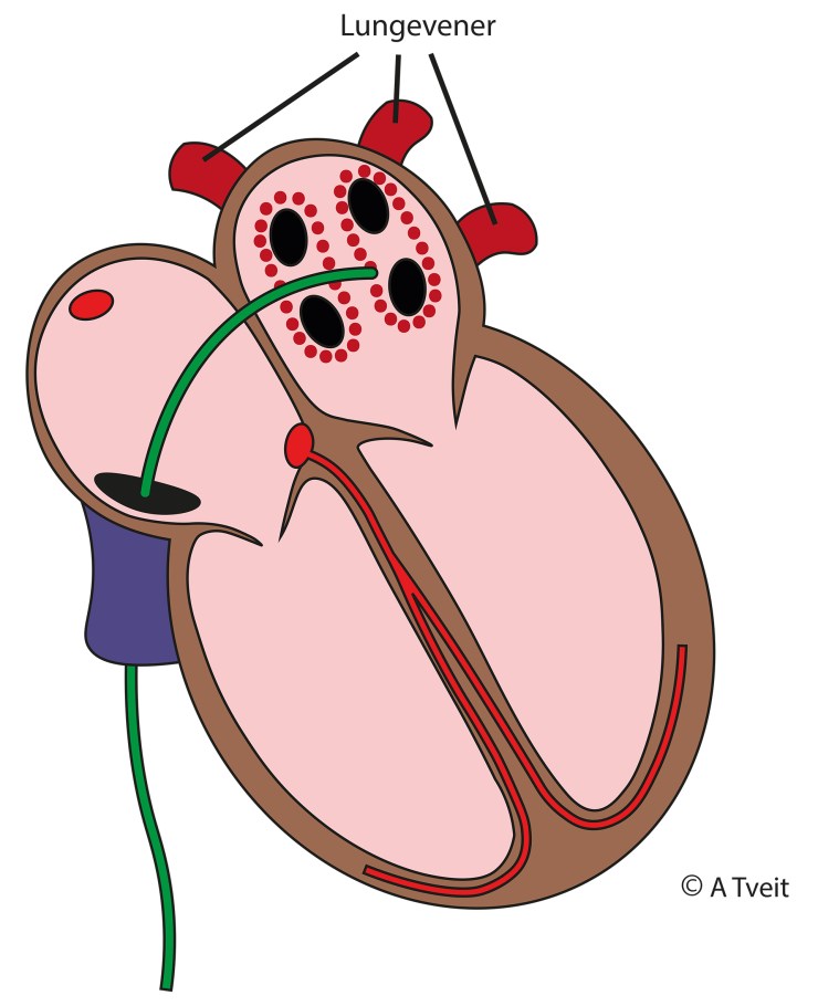 200229 Ablasjon med lungevener
