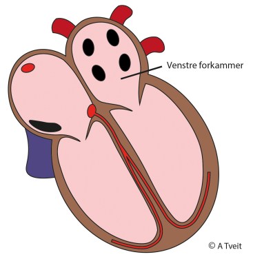 200229 Hjerte 11 vesntre forkammer